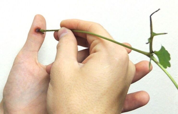 rimozione di una verruca su un dito con succo di erbe celidonia