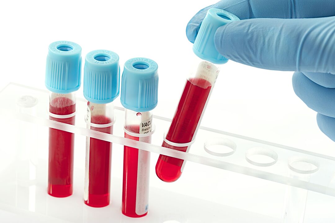 analisi del sangue per diagnosticare il papillomavirus umano